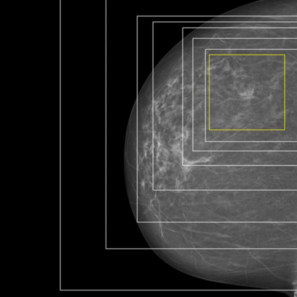 Mammogram where a deep neural network has identified cancer, with explainable AI highlighting the detected area.